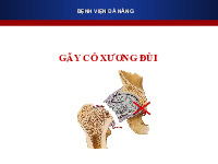 Bệnh án Gãy cổ xương đùi | Đại học Đà Nẵng